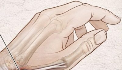 Why Do Your Hands Fall Asleep? Common Causes and Natural Remedies That Actually Work